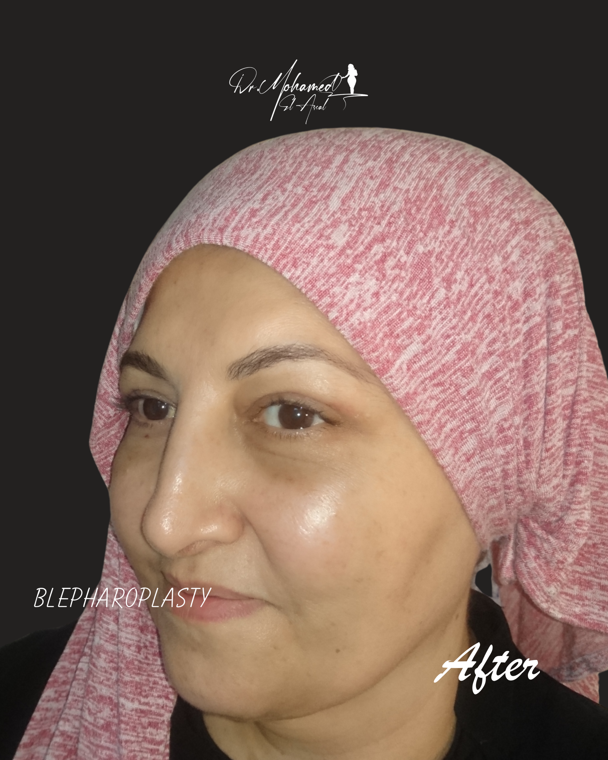 Deep Plane Facelift