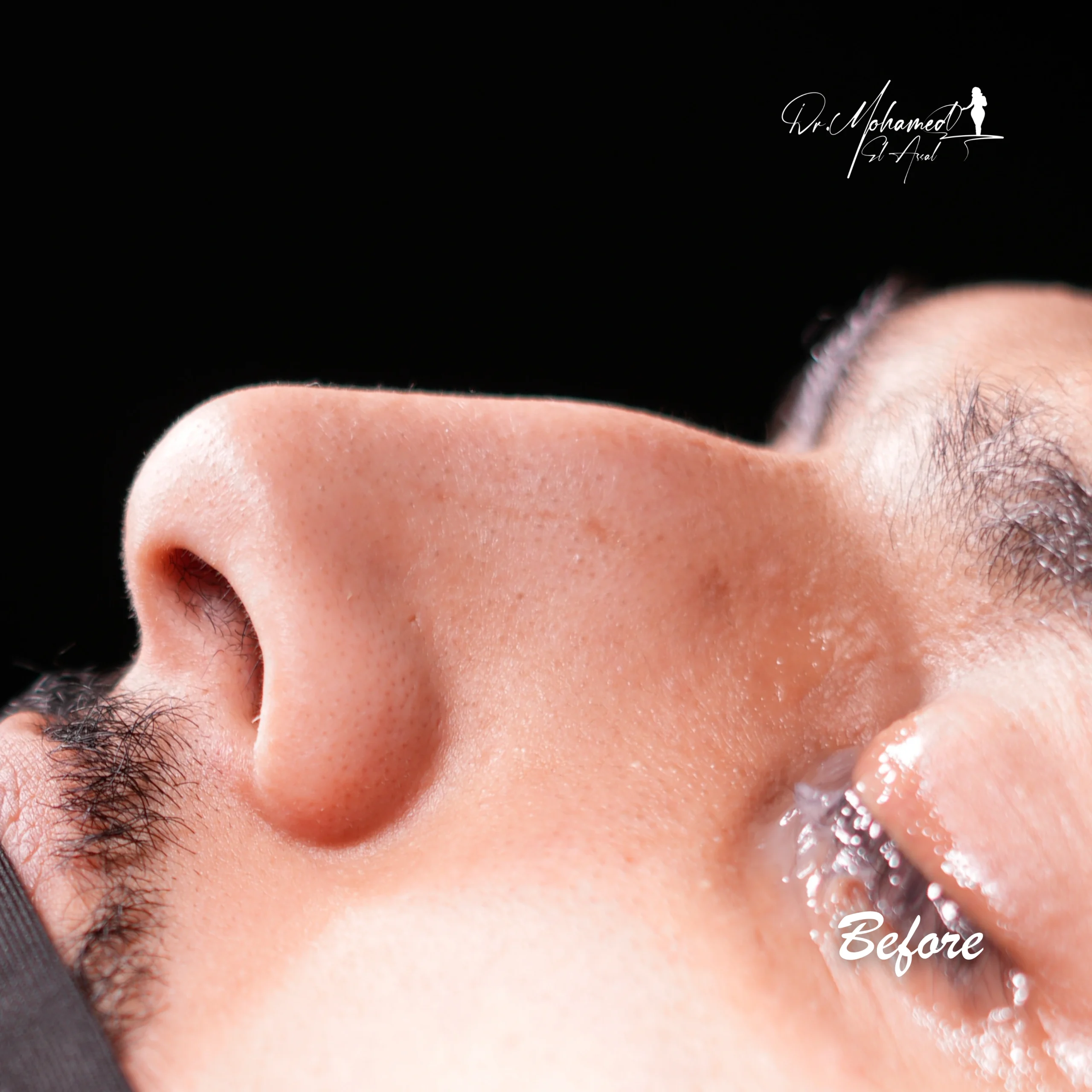 Before and After Rhinoplasty