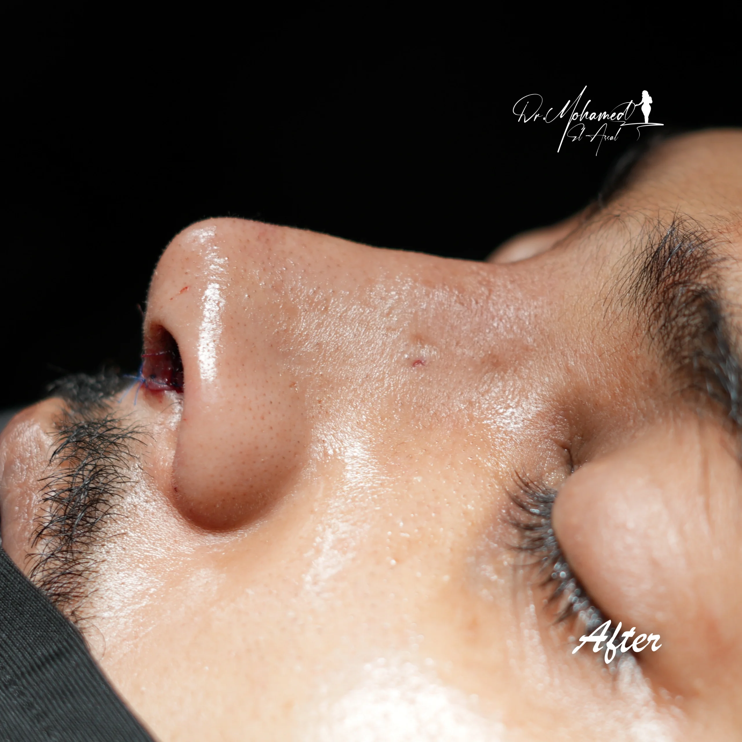 Before and After Rhinoplasty