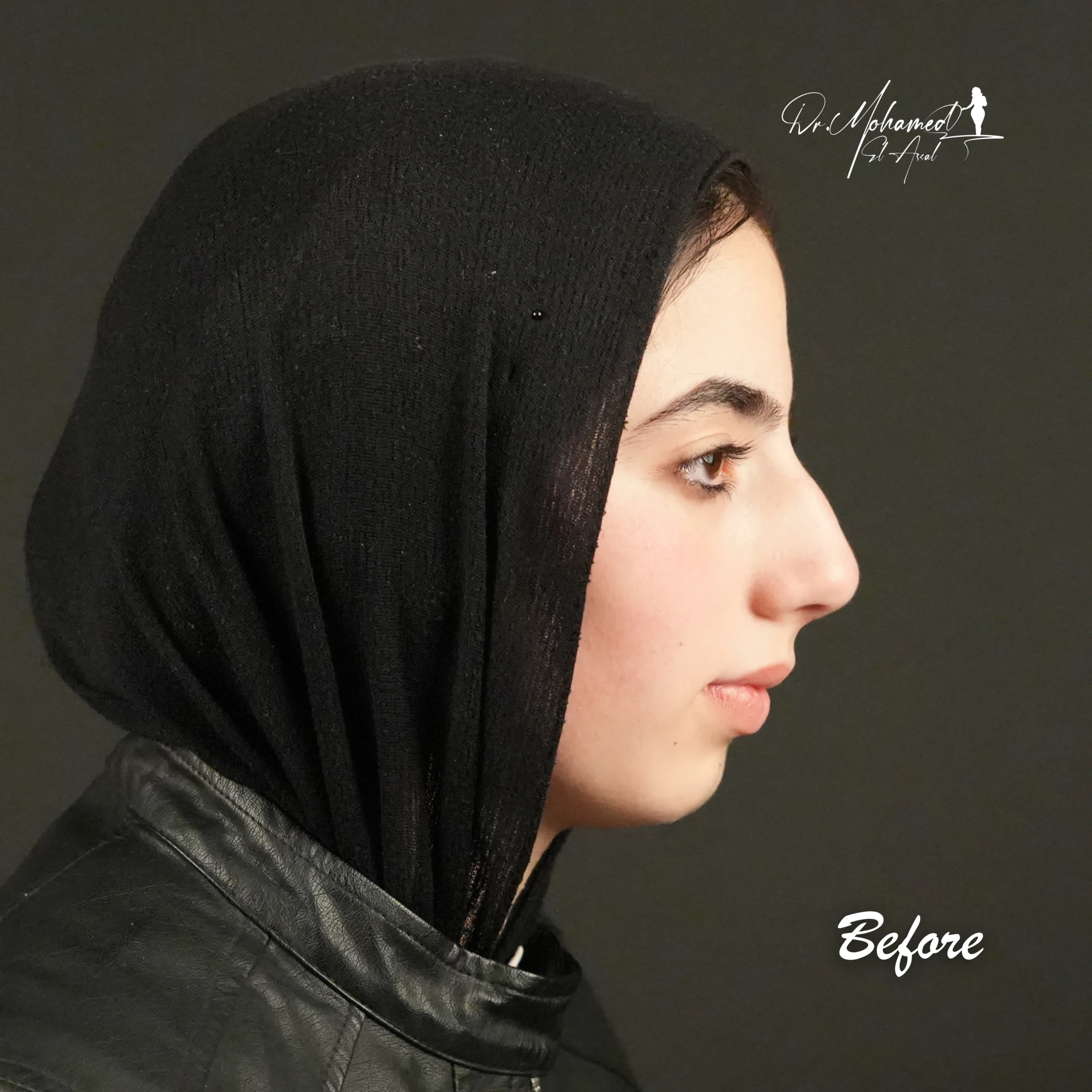 Before and After Rhinoplasty