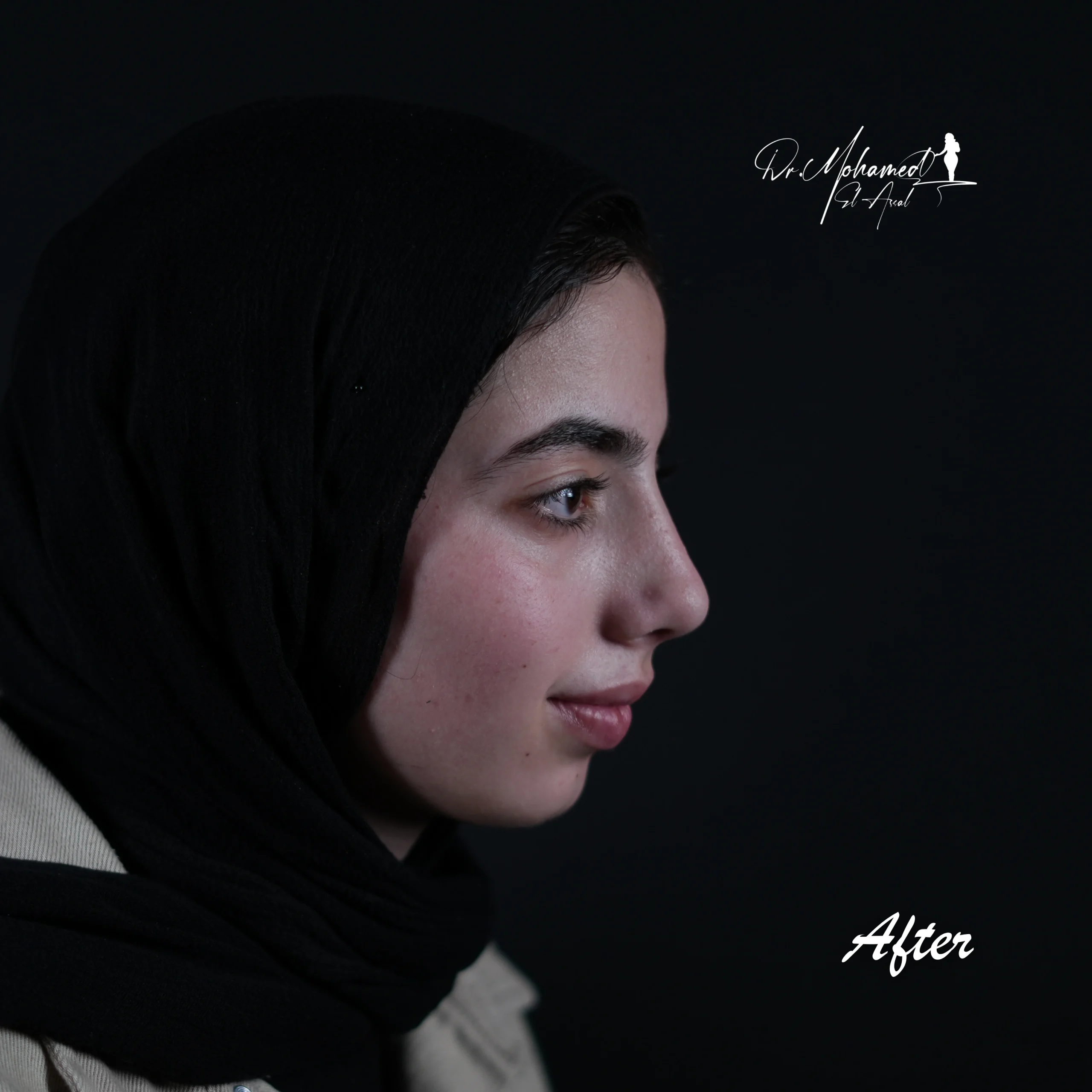 Before and After Rhinoplasty