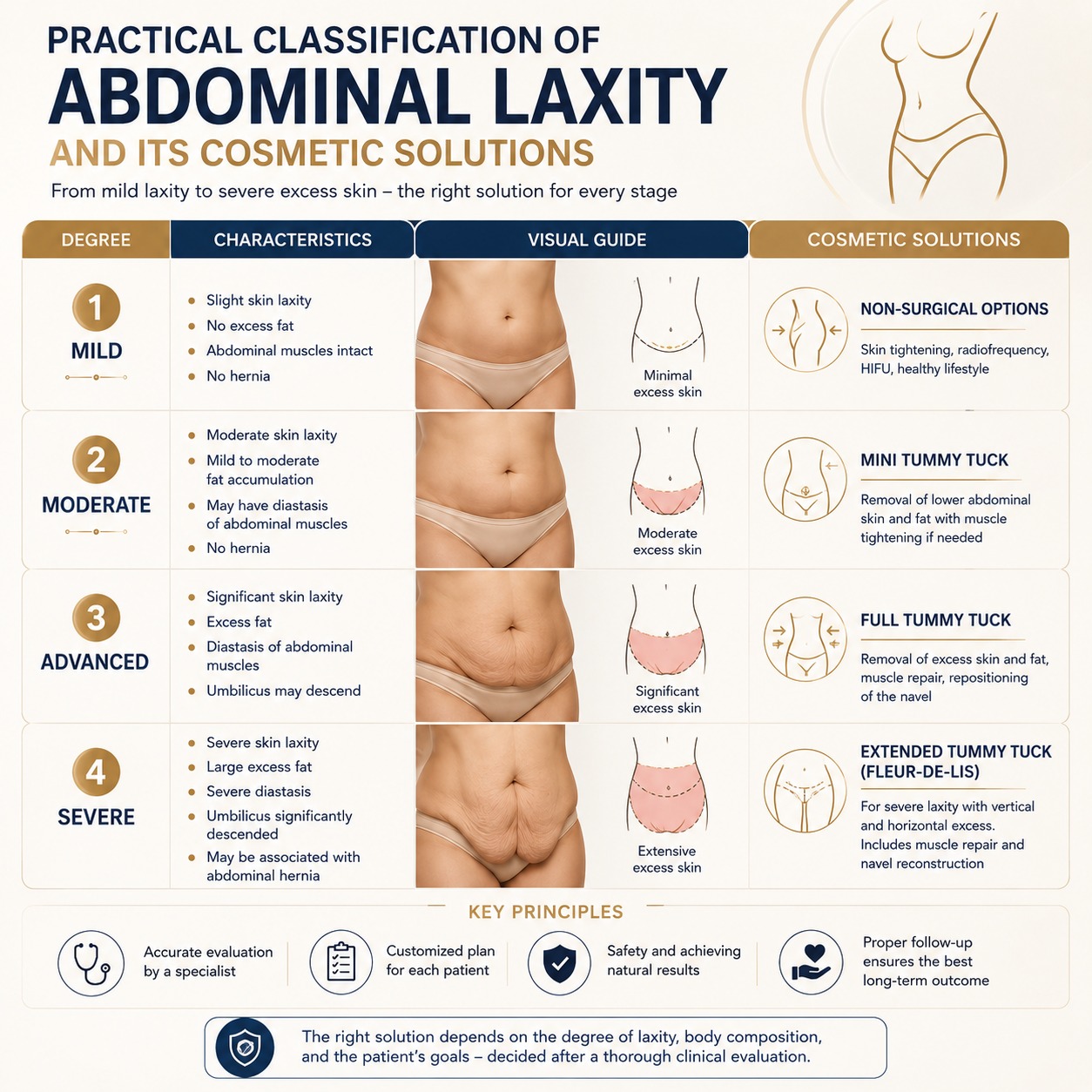 Medical illustration of abdominal laxity grades