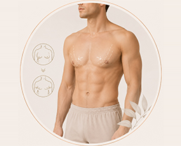Gynecomastia