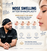 Infographic showing the stages of nose swelling recovery after rhinoplasty